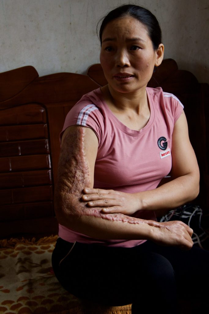 Tieu sitting and showing her arm where she was burned in the factory where she worked