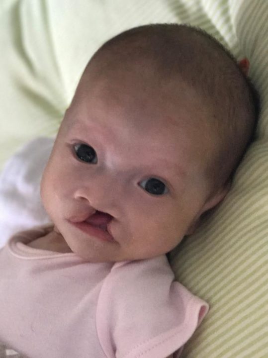 Rebekah with an unrepaired cleft lip, at the time she came into care at Holt's medical foster home in China. 