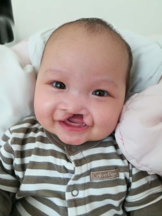 Rebekah just before cleft lip surgery, after she had gained weight at Holt's medical foster home.