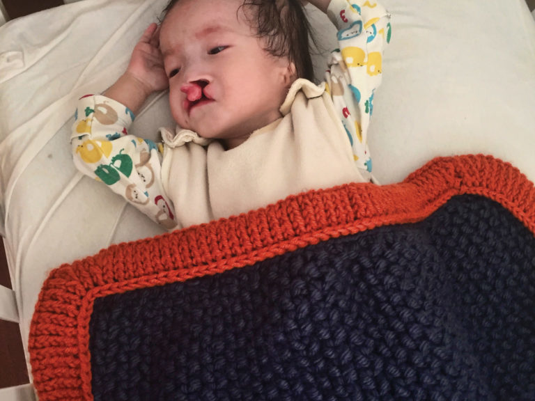 Baby with cleft lip in crib under blanket.