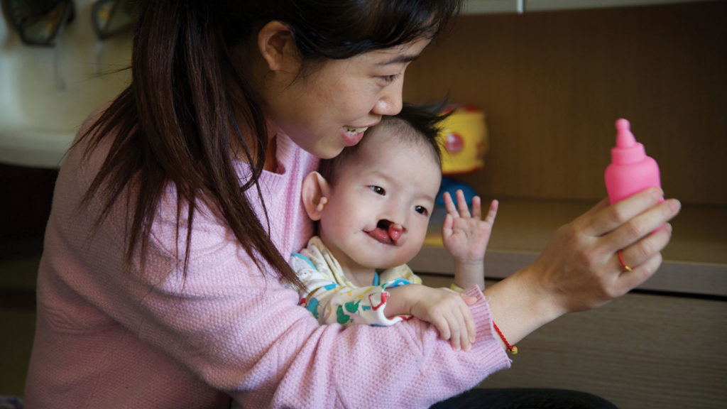 Child with cleft lip sitting with a caregiver